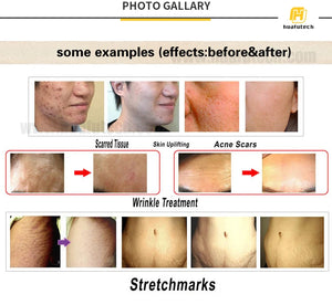 Hydra Microneedling stamps 0.25mm, 0.5mm