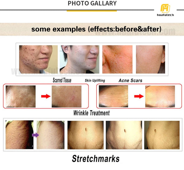 Hydra Microneedling stamps 0.25mm, 0.5mm